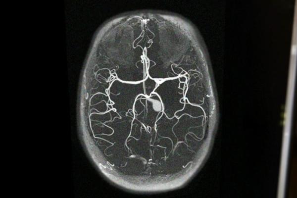 Рязанские врачи спасли мужчину с инсультом